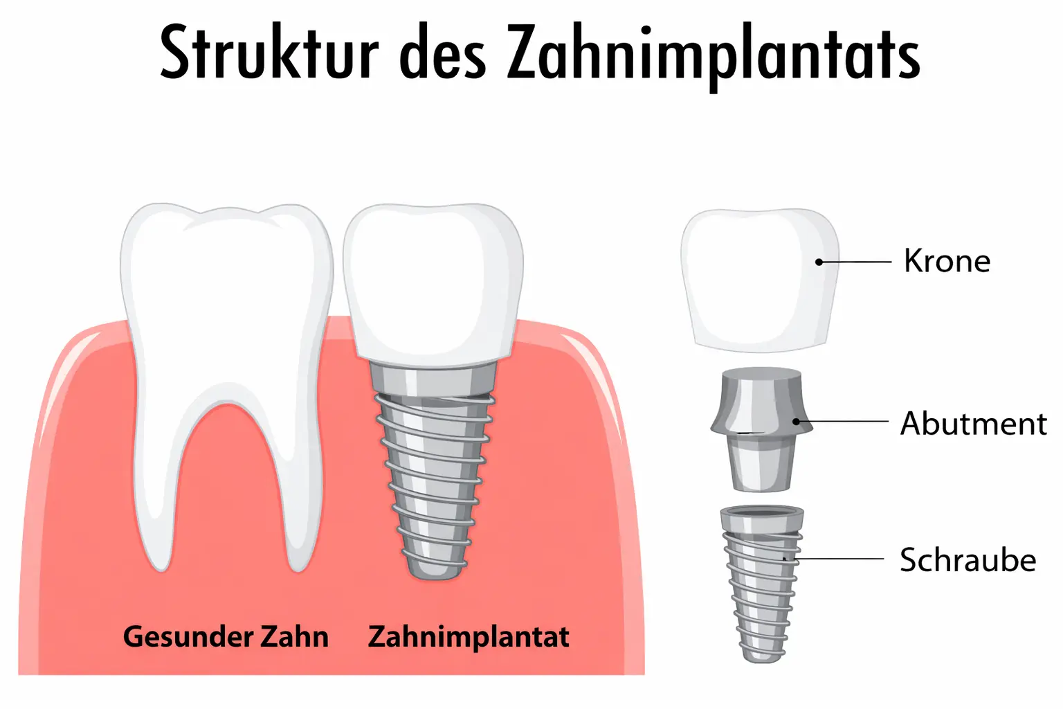 Schaubild: Aufbau und Funktion eines Zahnimplantats